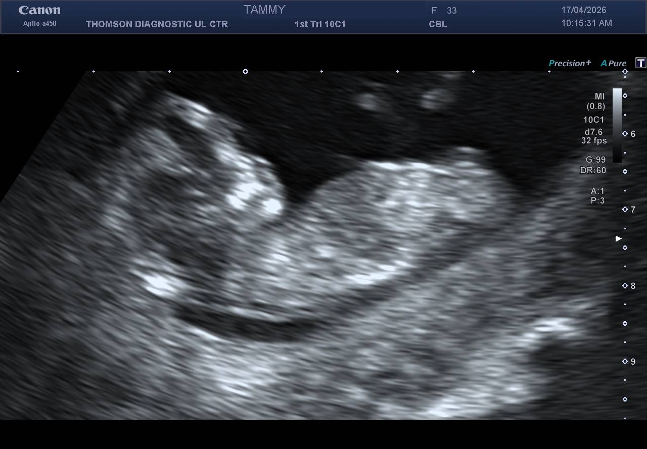 Ultrasound image
